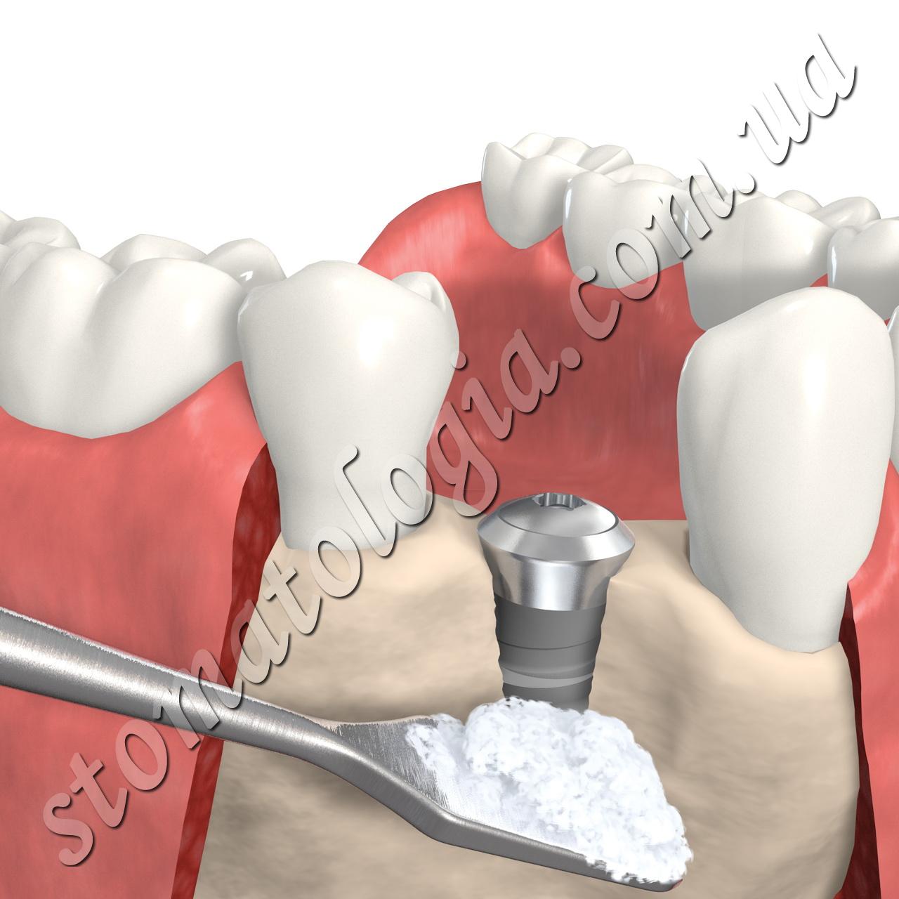 Наращивание кости при базальной имплантации зубов.